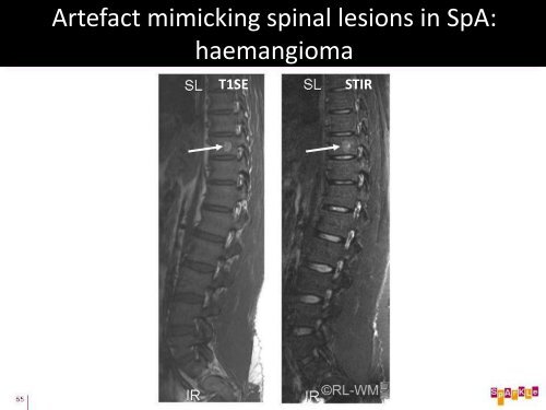 Pitfalls of MRI in Spondyloarthritis