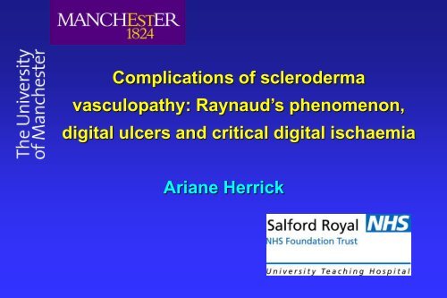 Raynaud's phenomenon, digital ulcers and critical digital ischaemia