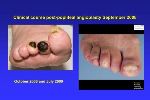 Raynaud's phenomenon, digital ulcers and critical digital ischaemia