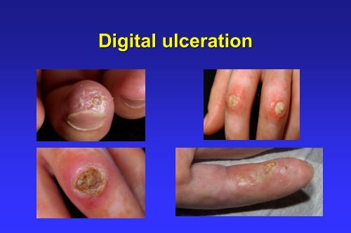 Raynaud's phenomenon, digital ulcers and critical digital ischaemia