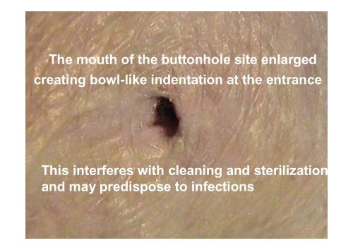 W20b Twardowski 1 Buttonhole Method of Fistula ... - SFAV