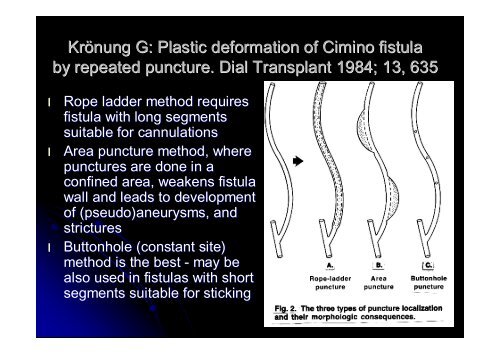 W20b Twardowski 1 Buttonhole Method of Fistula ... - SFAV