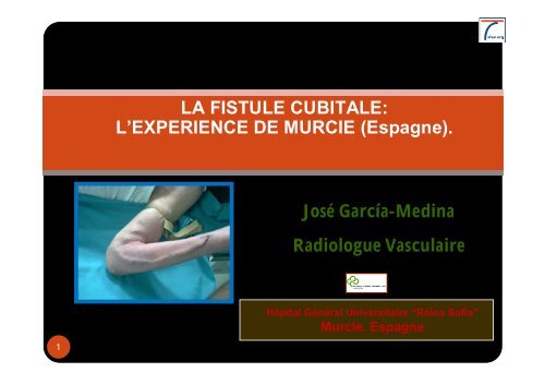 fistules cubitales - SFAV