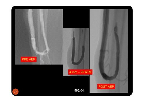 fistules cubitales - SFAV