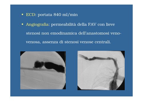 W15e Toni Trasposizione vena ascellare 2.ppt [Lecture seule] - SFAV