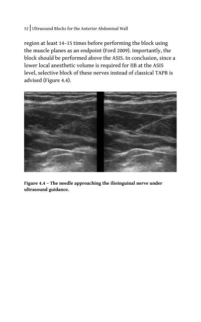 Ultrasound Blocks for the Anterior Abdominal Wall