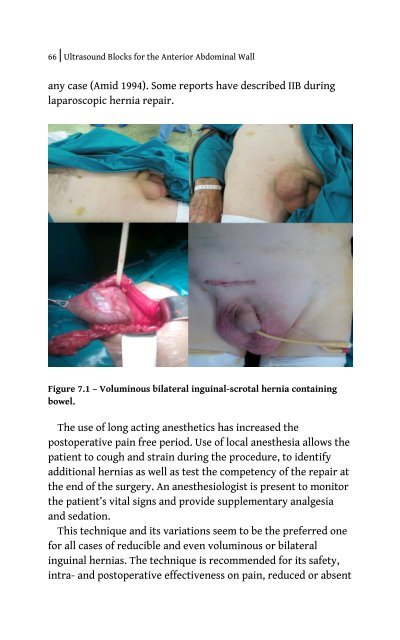 Ultrasound Blocks for the Anterior Abdominal Wall