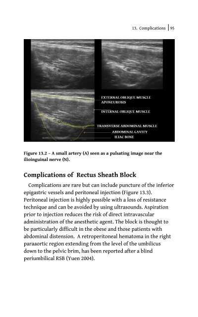 Ultrasound Blocks for the Anterior Abdominal Wall