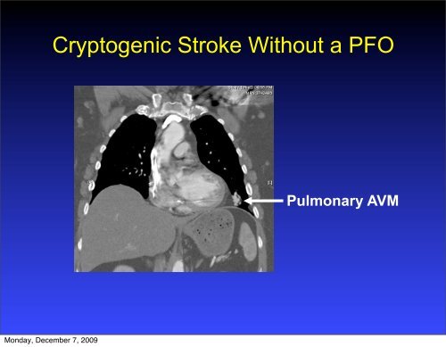 Patent Foramen Ovale (PFO) Closure From Strokes to Migraines ...