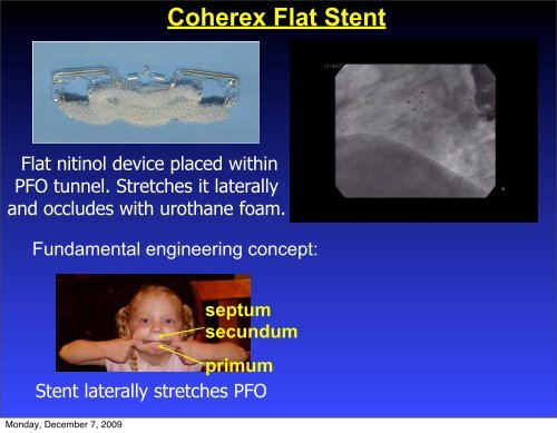 Patent Foramen Ovale (PFO) Closure From Strokes to Migraines ...