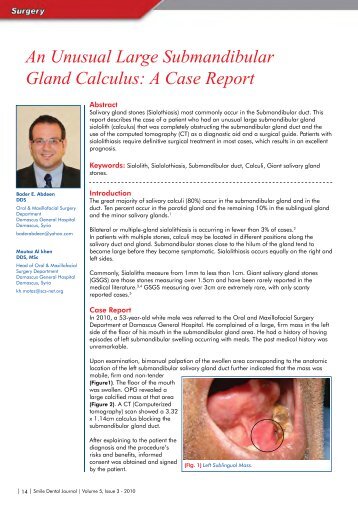 An Unusual Large Submandibular Gland Calculus: A Case Report