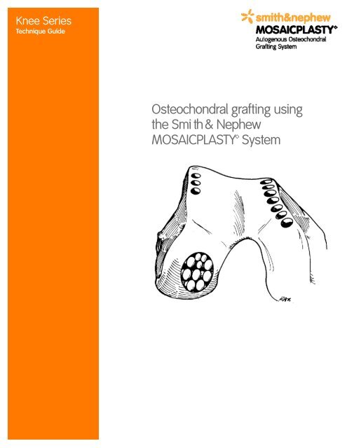 Osteochondral grafting using the Smith & Nephew MOSAICPLASTY ...