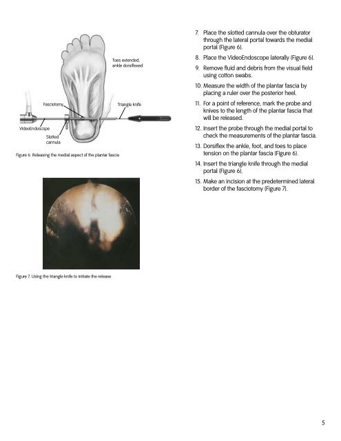 Endoscopic Plantar Fascia Release Using the Smith & Nephew ...