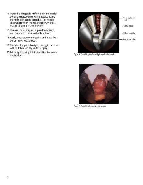 Endoscopic Plantar Fascia Release Using the Smith & Nephew ...