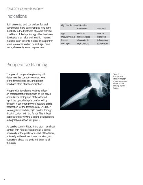 SYNERGY Cementless - Smith & Nephew