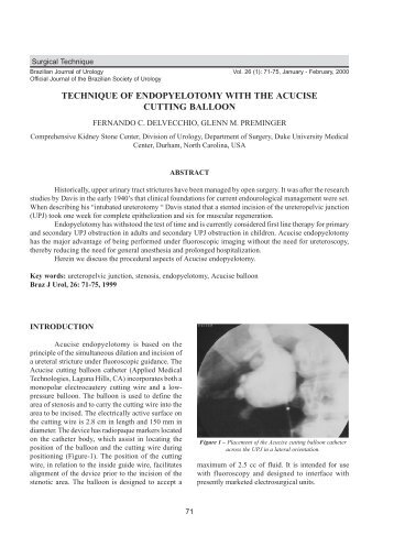 technique of endopyelotomy with the acucise cutting balloon