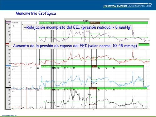 Chagas y Sistema digestivo