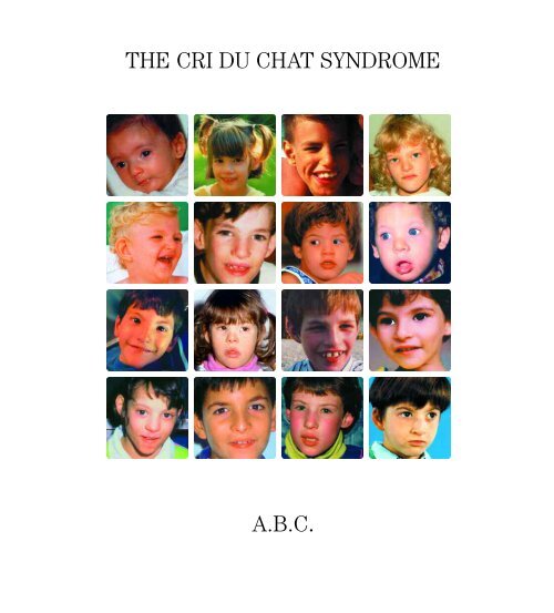 Cri du chat symptoms