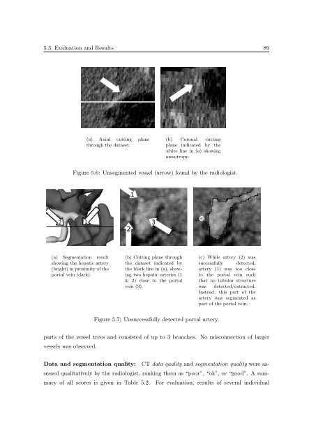 Segmentation of 3D Tubular Tree Structures in Medical Images ...