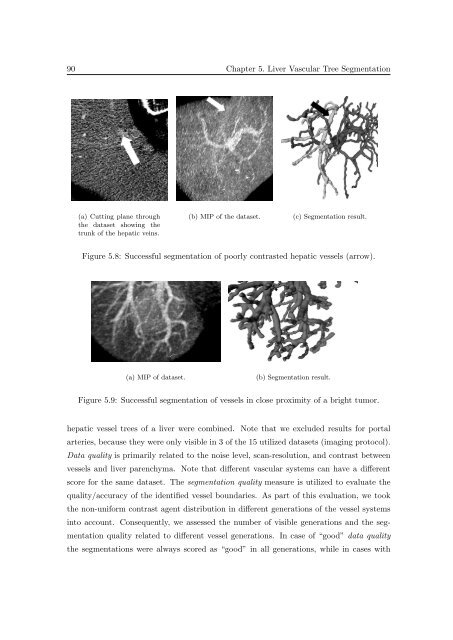 Segmentation of 3D Tubular Tree Structures in Medical Images ...