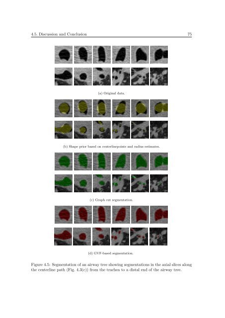 Segmentation of 3D Tubular Tree Structures in Medical Images ...