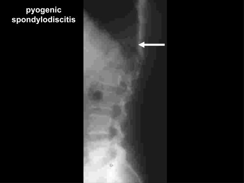 Discitis And Vertebral Osteomyelitis