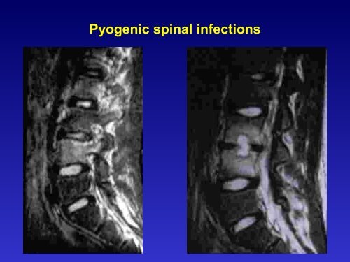 Discitis And Vertebral Osteomyelitis