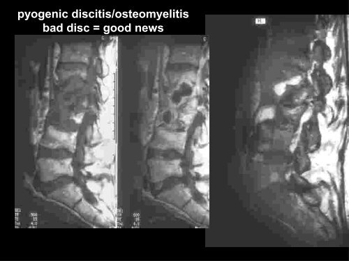 Discitis And Vertebral Osteomyelitis