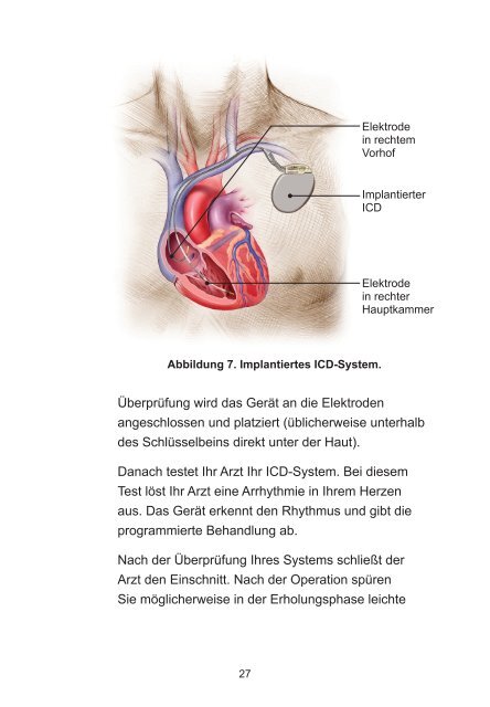 Implantierbarer Cardioverter/ Defibrillator- Therapie - Boston Scientific