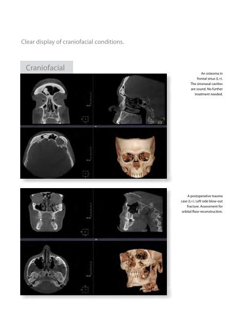 SCANORAÂ® 3Dx / PDF Brochure US - Soredex