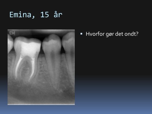 Behandling af akutte endodontiske tilstande