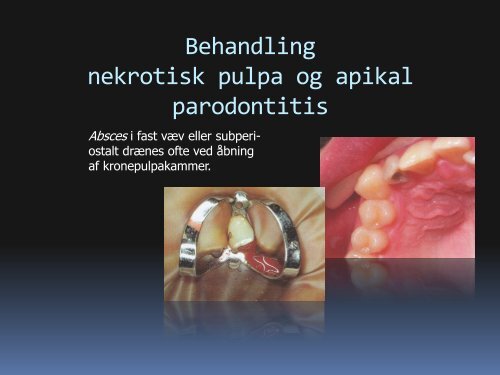 Behandling af akutte endodontiske tilstande