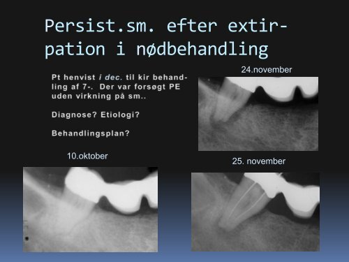 Behandling af akutte endodontiske tilstande