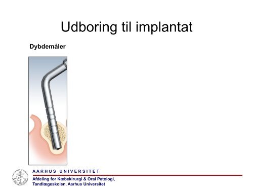 Principper for den kirurgiske indsÃ¦ttelse - TandlÃ¦geskolen - Aarhus ...