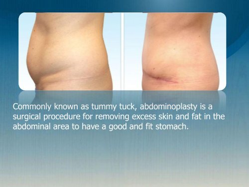 Tummy Tuck orange county - Benefits of Abdominoplasty