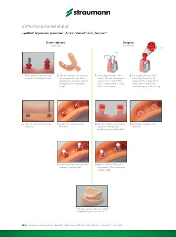 Screw-retained