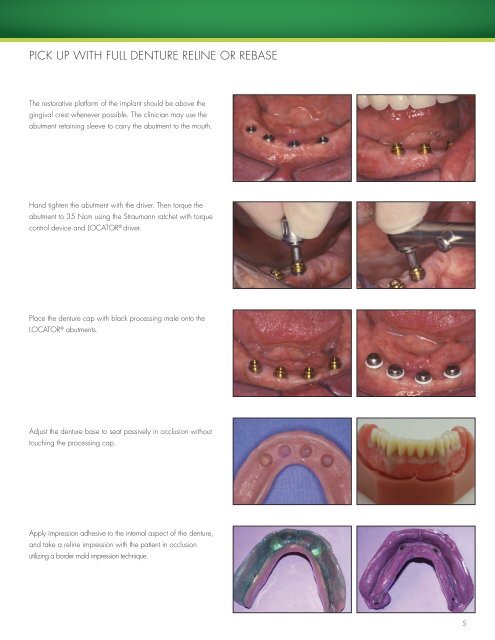 restoring straumann implants with locator® abutments