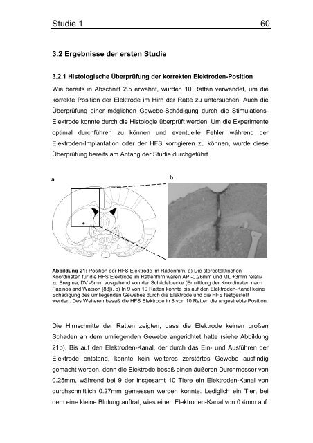 „Einfluss der elektrischen Hochfrequenzstimulation des Nucleus ...