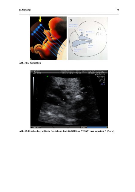Fetale Echokardiographie an einem tertiären Zentrum für Pränatale ...