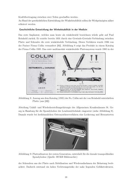 Der Druckplattenfixateur zur Pseudarthrosenbehandlung am Femur