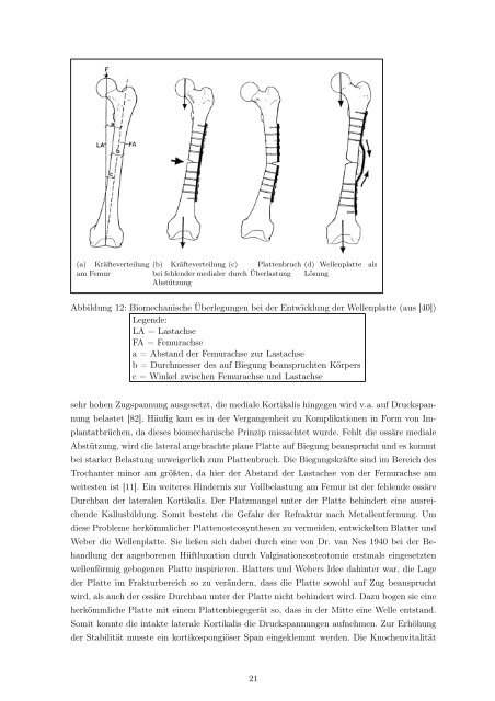 Der Druckplattenfixateur zur Pseudarthrosenbehandlung am Femur