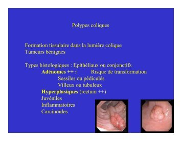 Polypes cancer