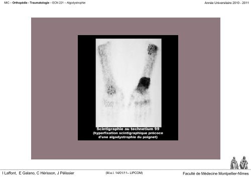 L 'ALGODYSTROPHIE - Faculté de médecine de Montpellier