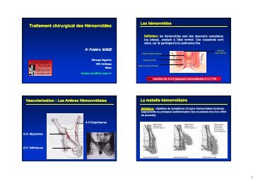 Traitement chirurgical des Hémorroïdes
