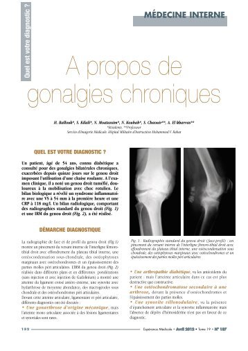 A propos de gonalgies chroniques - Pharmacies.ma