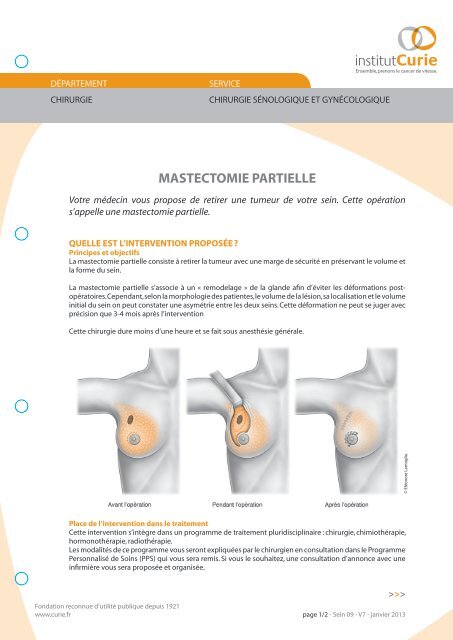 MASTECTOMIE PARTIELLE - Cancers du Sein - Institut Curie