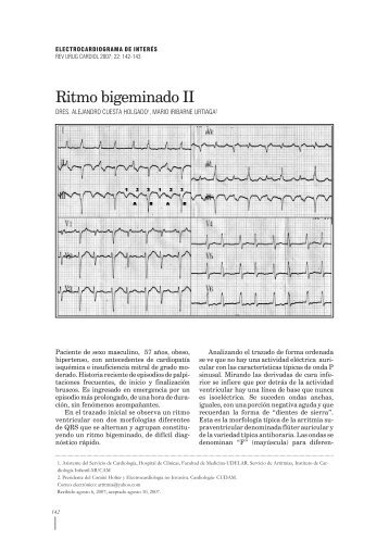 Ritmo bigeminado II