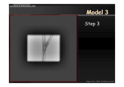 Insight of Various Bifurcation Stenting Techniques ... - summitMD.com