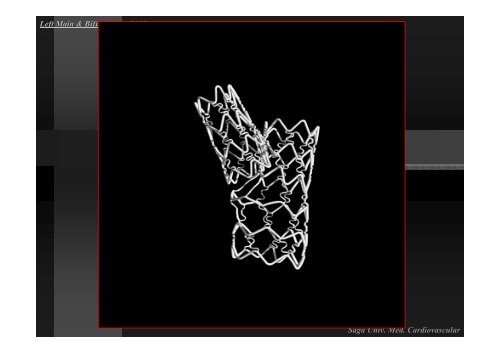 Insight of Various Bifurcation Stenting Techniques ... - summitMD.com