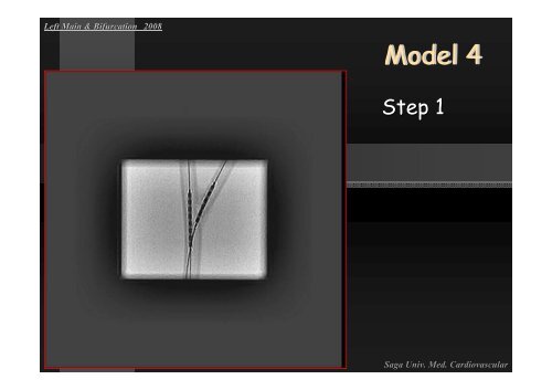 Insight of Various Bifurcation Stenting Techniques ... - summitMD.com